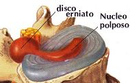 disco-erniato.jpg