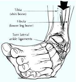 distorsione caviglia