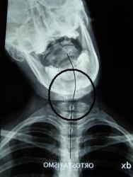 lateral bend markings