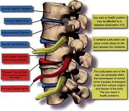 Sublussazione Vertebrale