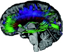 tractography